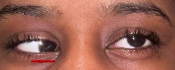 Ria's eyes showing her strabismus