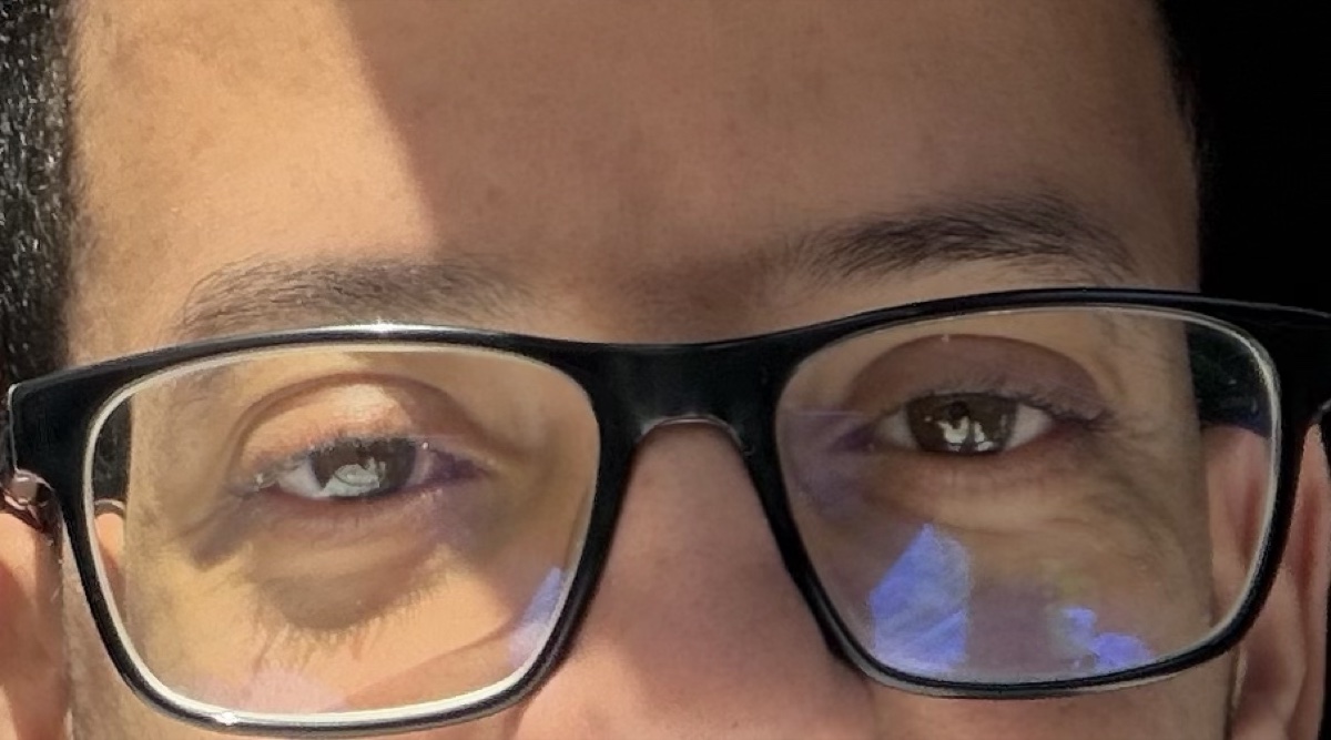 Fadel today, eyes straight and fully healed after strabismus surgery