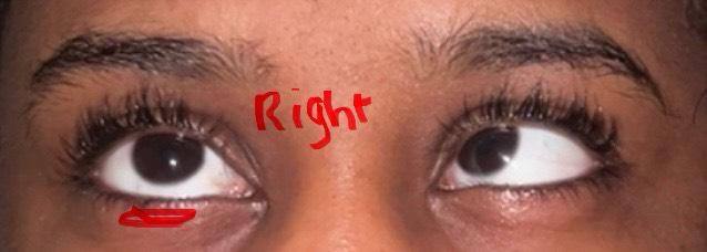 Ria's strabismus from another angle